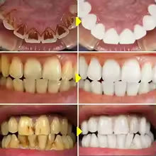 Stylo blanchissant pour les dents - SnowTooth | Veiggara.
