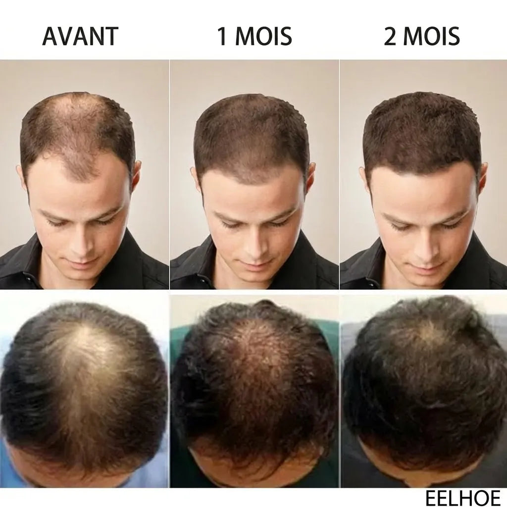 Ginger Hair | Huile pour la croissance des cheveux et le traitement de la calvitie | Veiggara